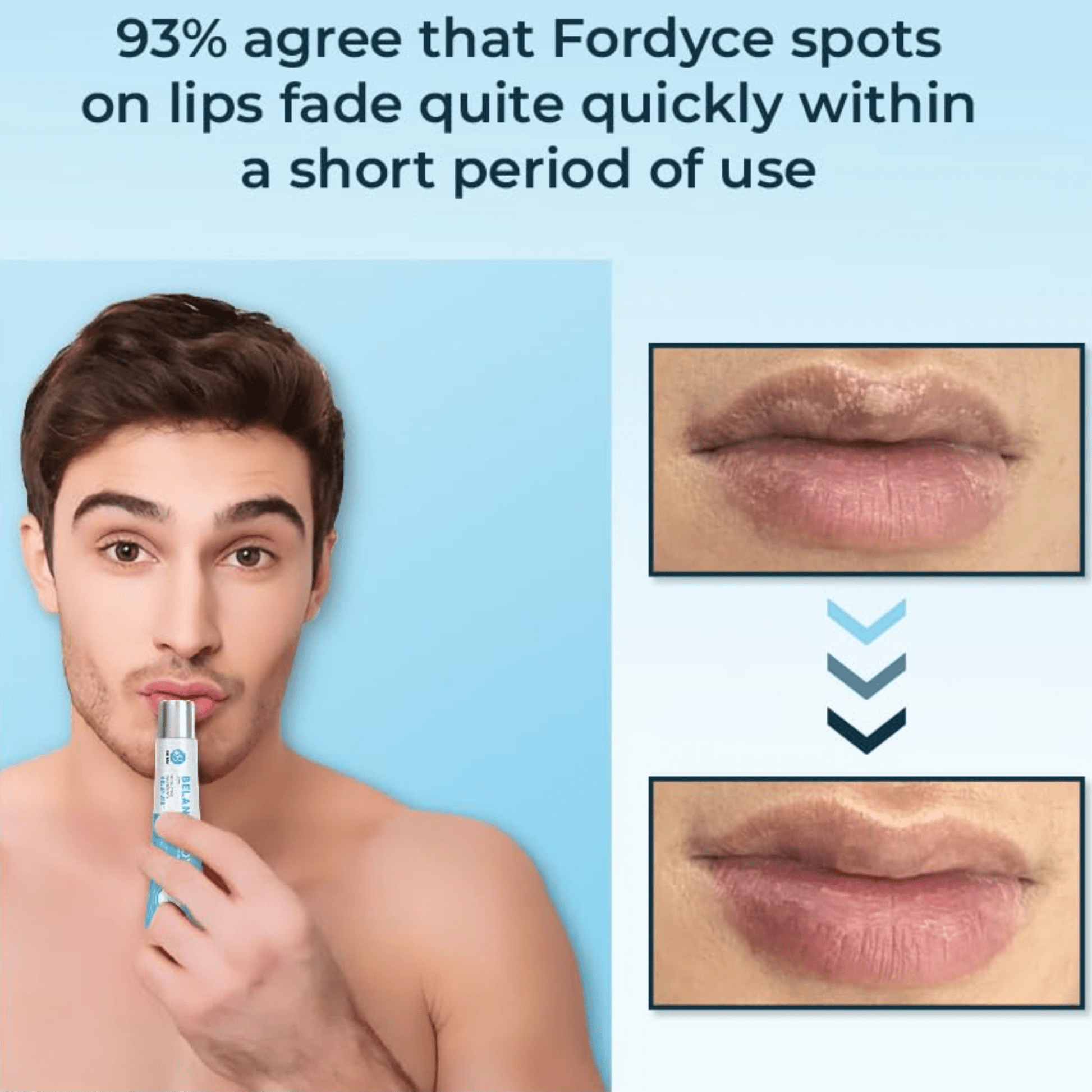 Belani Fordyce Spots Lip Cream, Traitement hydratant pour lèvres foncées, Graines de Fordyce 0,7 fl oz