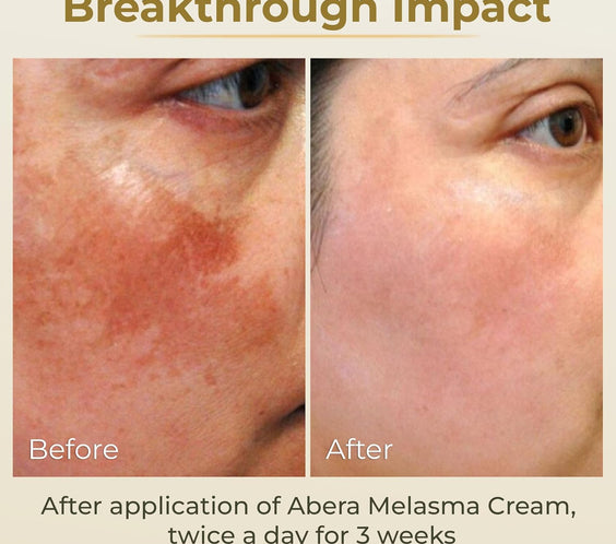 Crème anti-mélasma ABERA