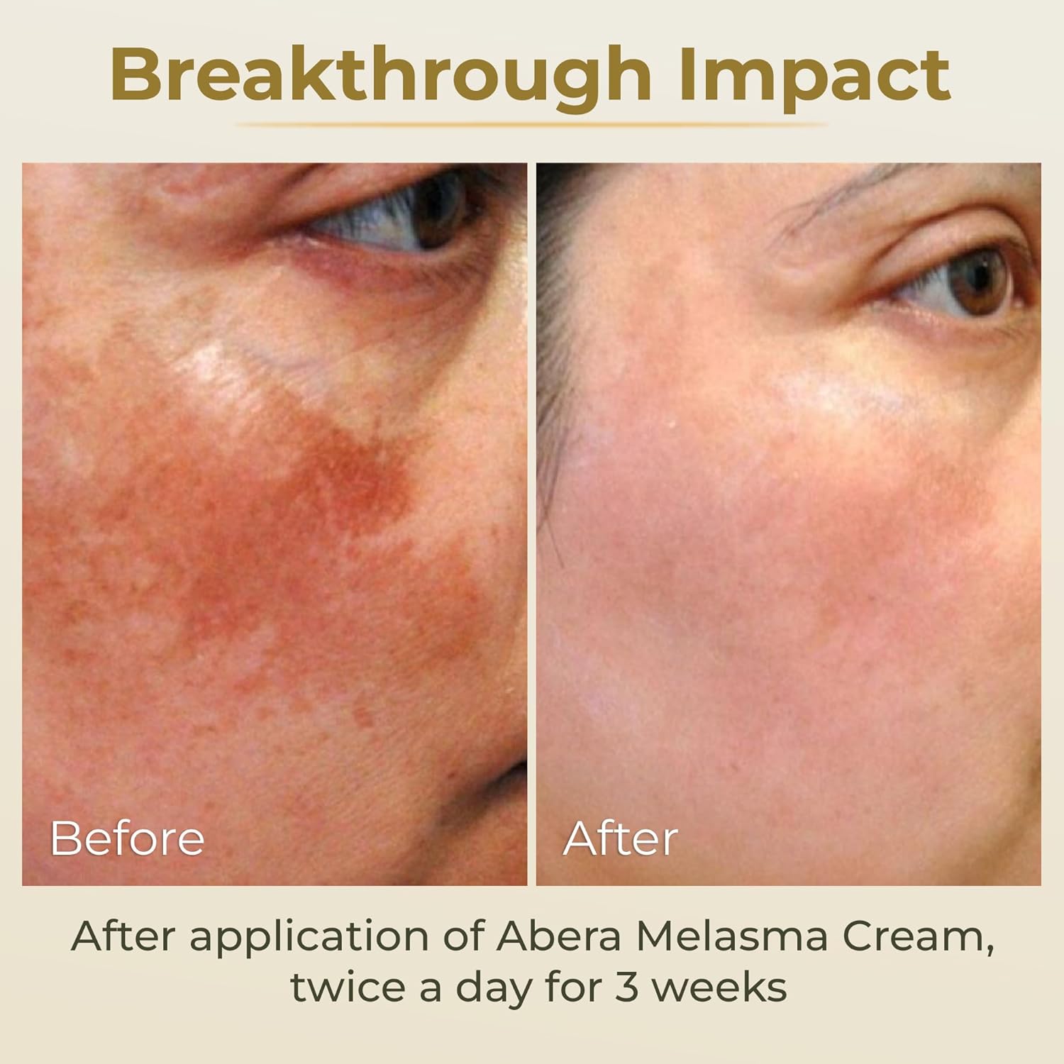 Crème anti-mélasma ABERA