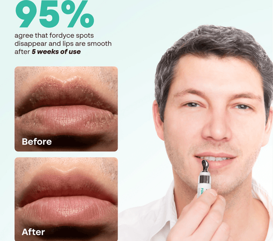 Abera Fordyce Cream – Advanced Formula with HPR (Next-Gen Retinoids), For Lip Acne, Dry, Chapped Lips (0.7 Oz)