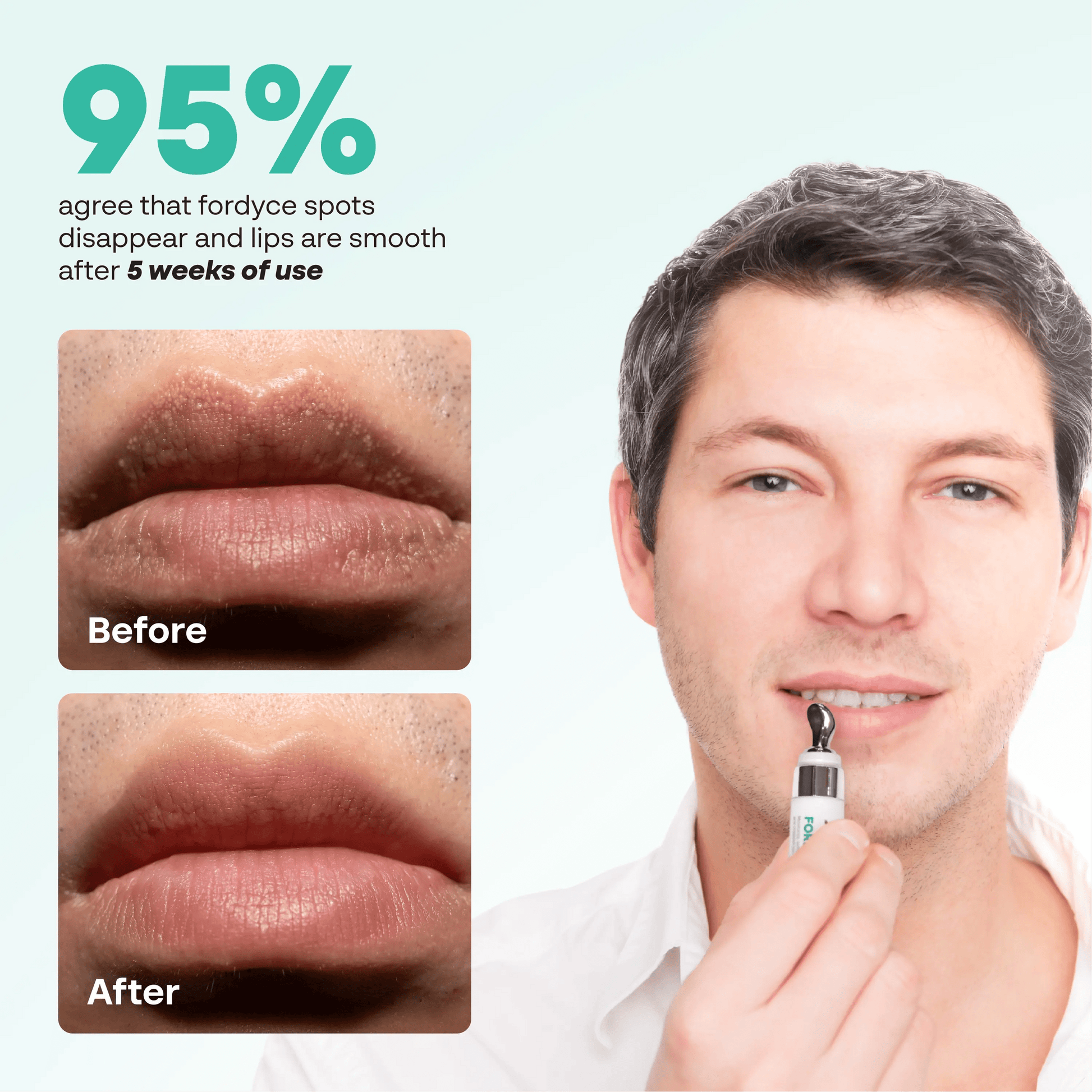 Abera Fordyce Cream – Advanced Formula with HPR (Next-Gen Retinoids), For Lip Acne, Dry, Chapped Lips (0.7 Oz)
