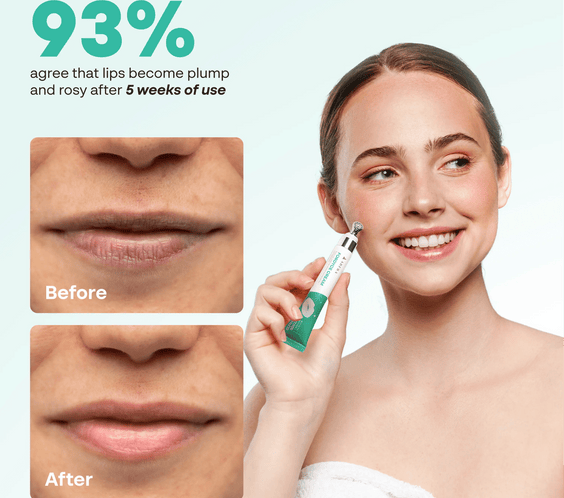 Abera Fordyce Cream – Advanced Formula with HPR (Next-Gen Retinoids), For Lip Acne, Dry, Chapped Lips (0.7 Oz)