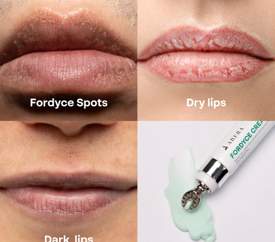 Abera Fordyce Cream – Advanced Formula with HPR (Next-Gen Retinoids), For Lip Acne, Dry, Chapped Lips (0.7 Oz)