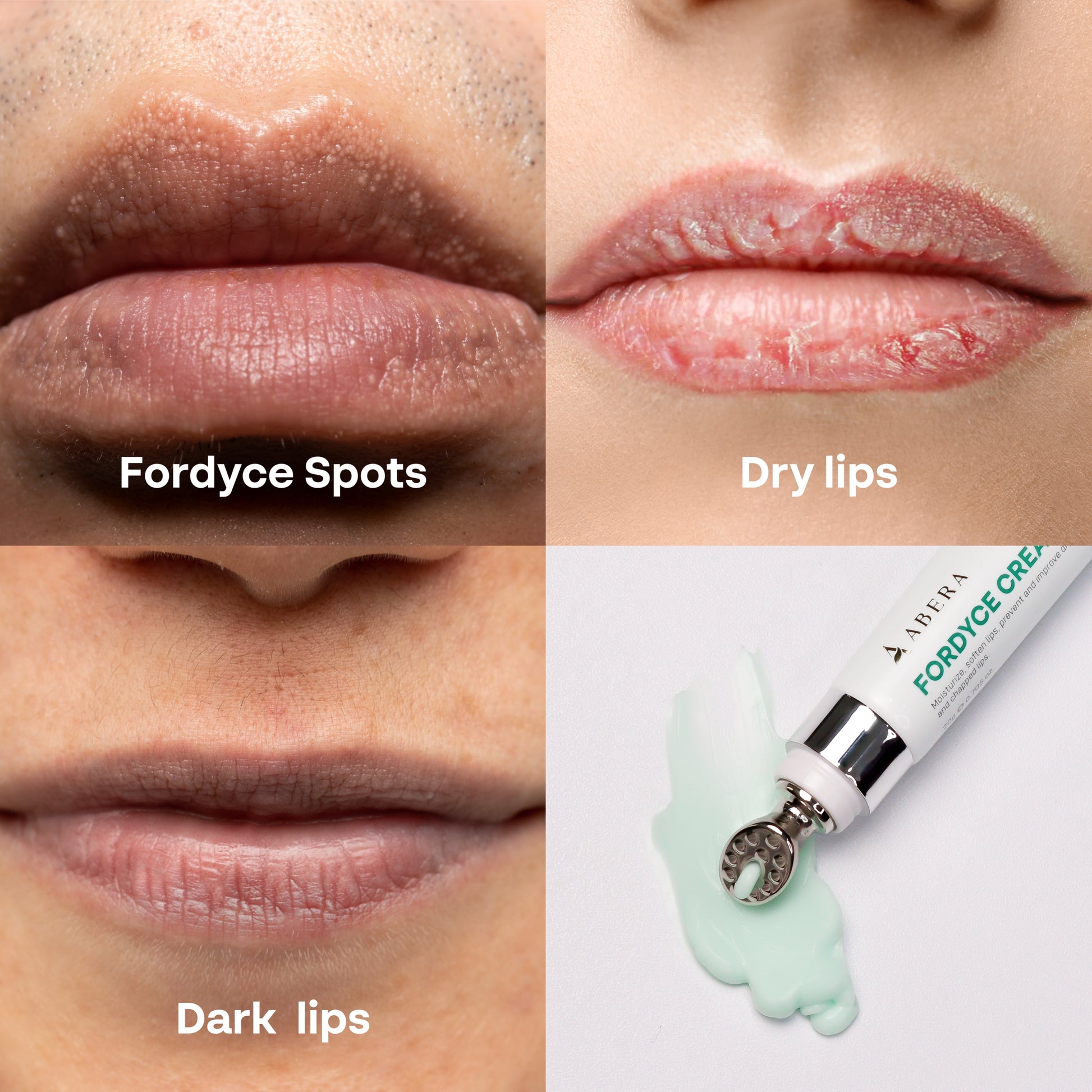 Abera Fordyce Cream – Advanced Formula with HPR (Next-Gen Retinoids), For Lip Acne, Dry, Chapped Lips (0.7 Oz)